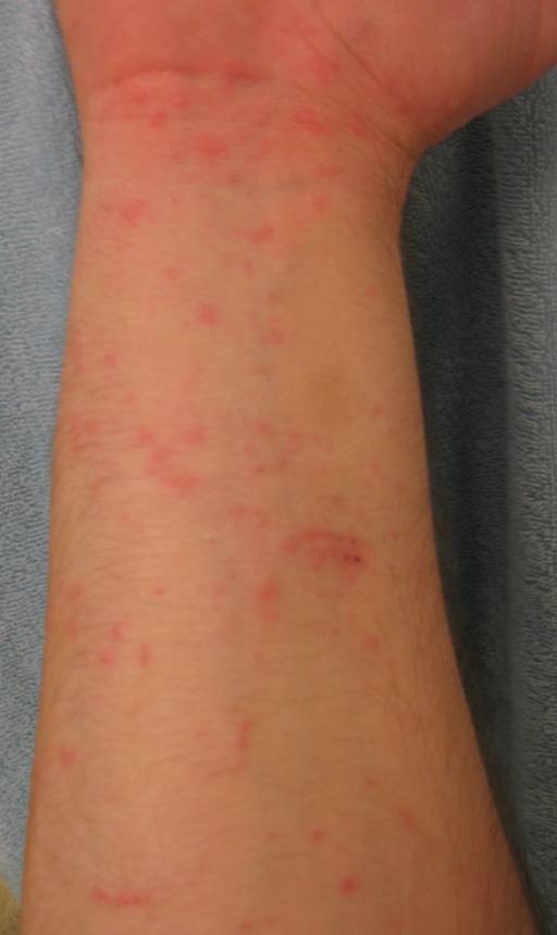 Is this poison oak / poison ivy (pics of my arms)