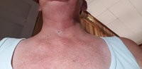 Lump on my chest 7-26-18.jpg