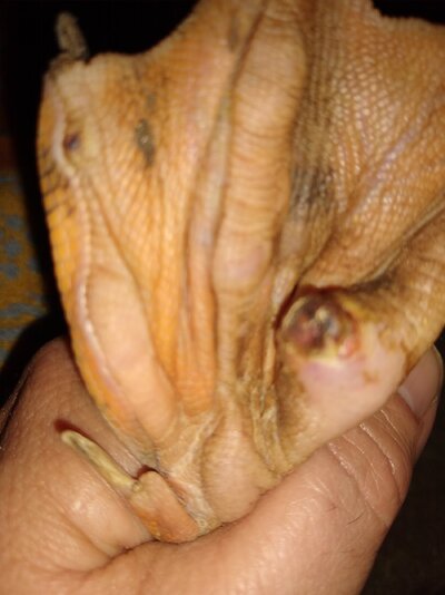 day 4 after removal.jpg