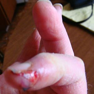 Always wear protective gloves when hammering within striking distance of chain link fence . I almost always did/do.