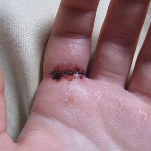 May 4, dressing removed, looking much better. Sore, but a couple Tylenol fixes that up for a while.