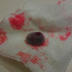 Tumor