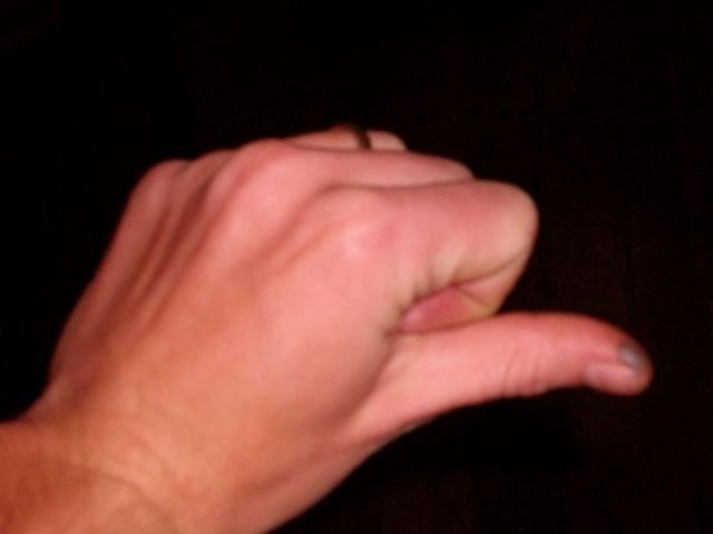 27985_thumbinjury.jpg