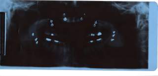 5415_x_ray_jaw.jpg