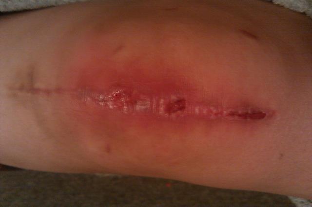 54632_knee8weeks.jpg