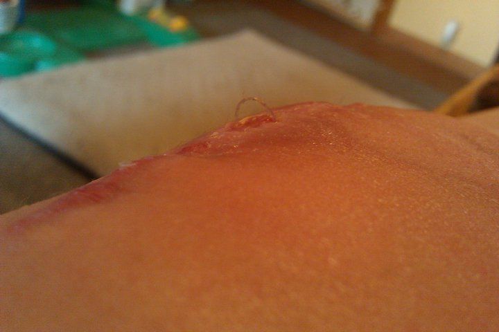 54632_kneesuture.jpg
