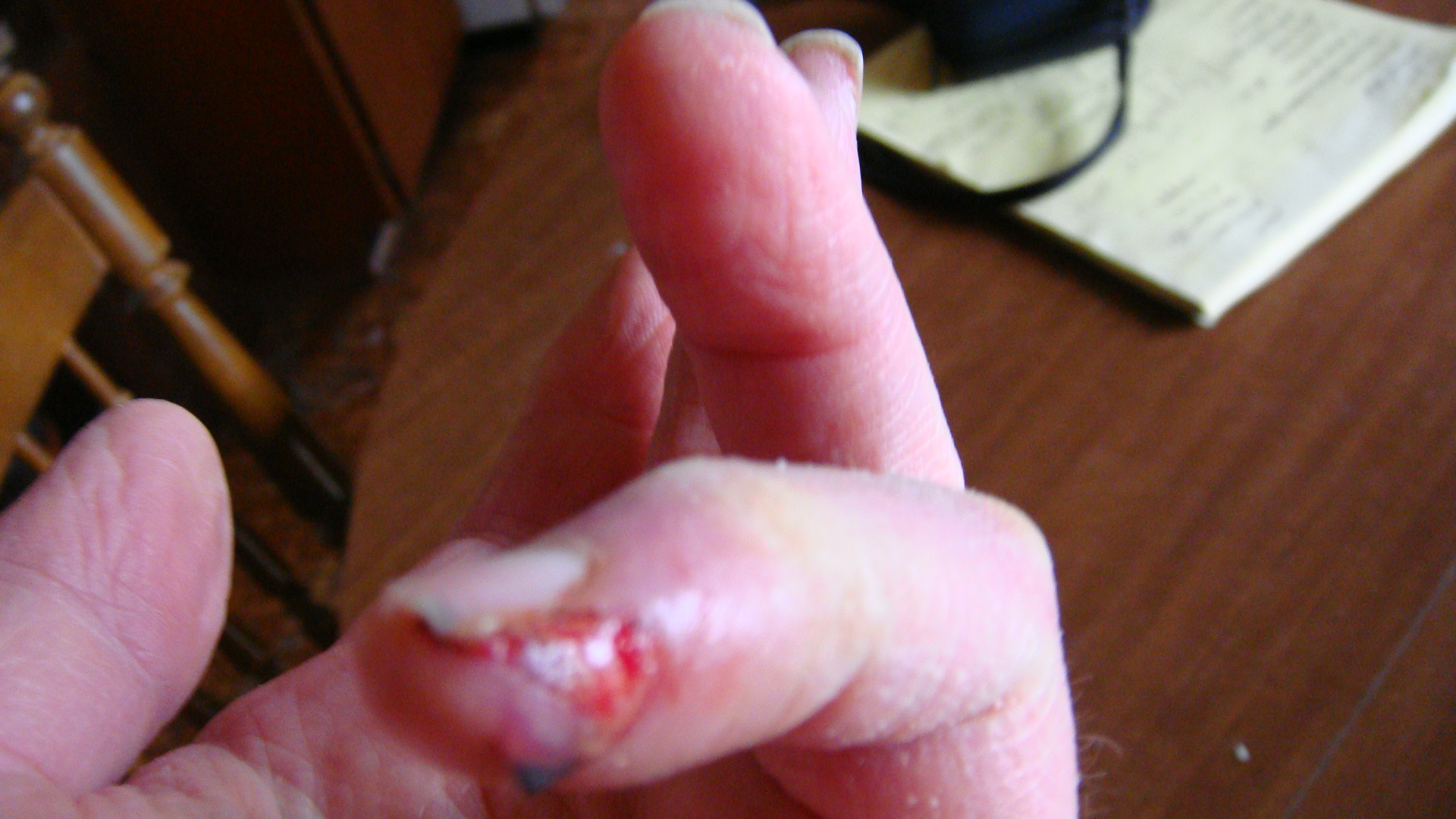 Always wear protective gloves when hammering within striking distance of chain link fence . I almost always did/do.