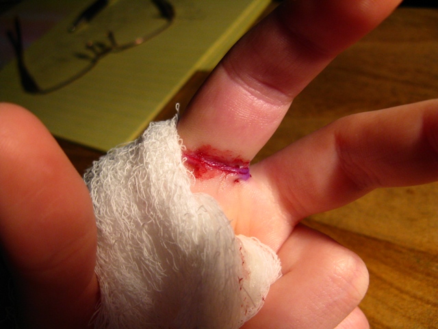 May 2, a couple hours after the surgery, finger was completely numb.