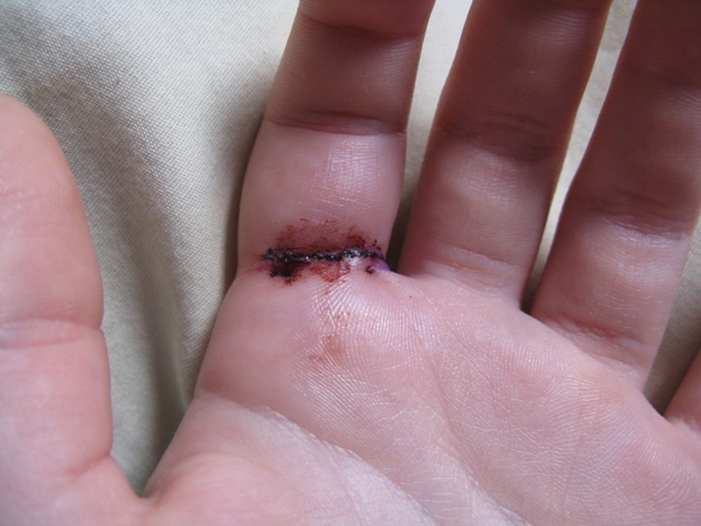 May 4, dressing removed, looking much better. Sore, but a couple Tylenol fixes that up for a while.
