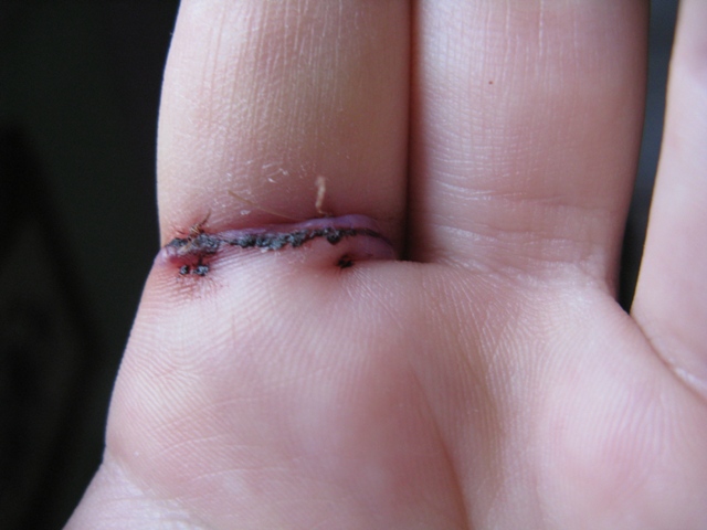 May 8, highly improved! I can fully extend and bend my finger -- just no squeezing into a fist.