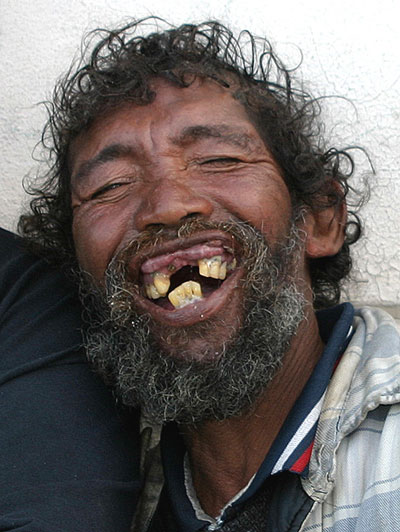 rotten-teeth-smile.jpg