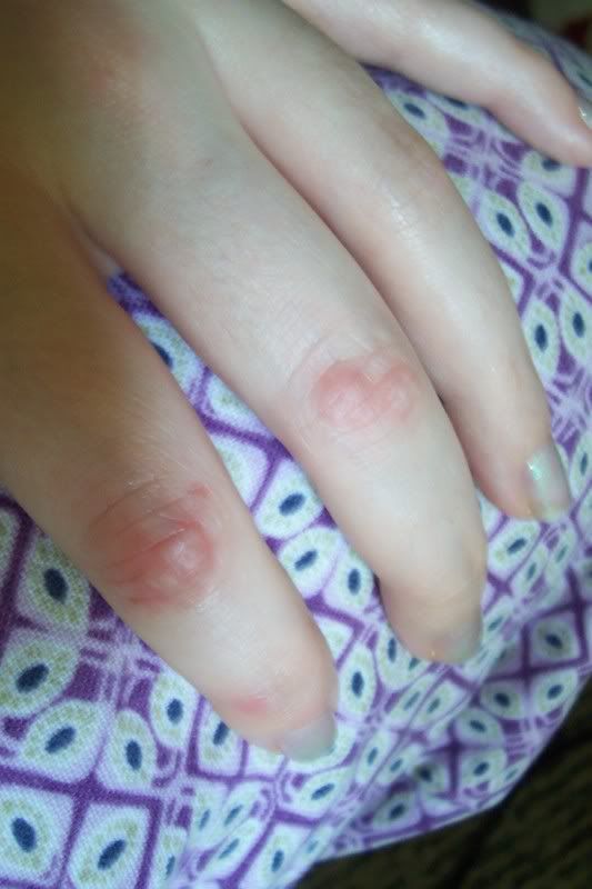 blister1.jpg