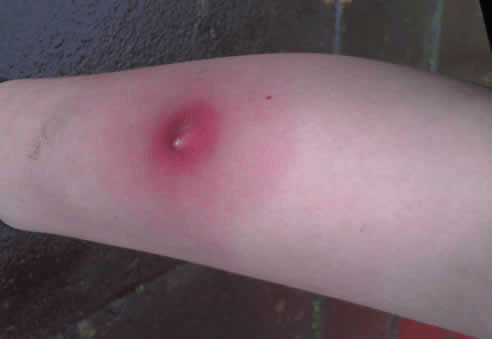 insect-bite.gif