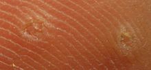 220px-Wart-IMG_1676.JPG