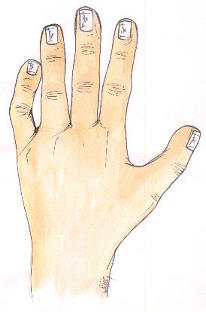 Clinodactyly01.jpg