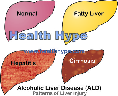 alcohol_liver.jpg
