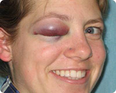 black-eye.jpg